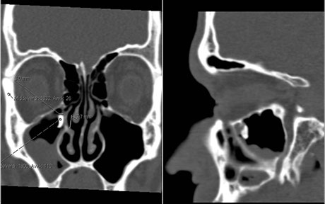 Bilde 3: CT-fremstilling av en tannrot med luksasjon mot taket til høyre sinus maxillaris.